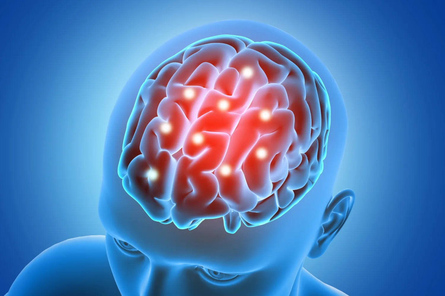 Evento vascular cerebral isquémico y trombectomía mecánica